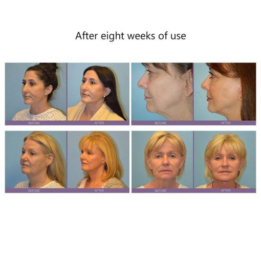 Anti-ageing Face-lifting device - Image 5